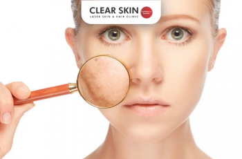 How to Fade Melasma Naturally: Your Complete Skin Care Guide How to Fade Melasma Naturally: Your Complete Skin Care Guide